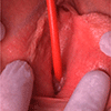 Image showing a catheter being inserted into a woman urethra.