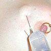 Needle injecting saline into a breast